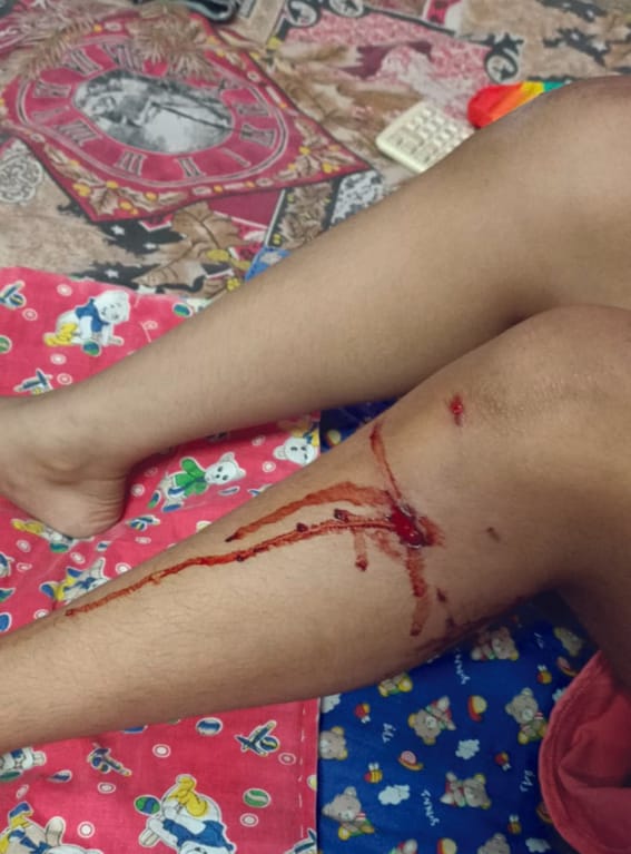 Girl bitten by stray dog